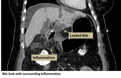 symptoms of bile leak|Biliary Leak